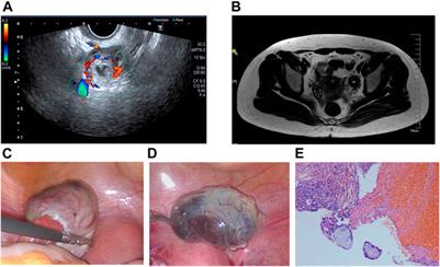 Unruptured ovarian ectopic pregnancy: Two case reports and literature review